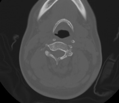 C7 laminar fracture and Klippel-Feil syndrome (Radiopaedia 86710-102850 Axial bone window 39).jpg