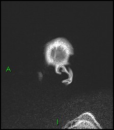 CNS manifestations of NF1 - optic pathway glioma, neurofibroma, dural ectasia (Radiopaedia 37874-39805 Sagittal FLAIR 4).jpg