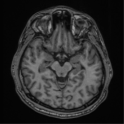 CNS vasculitis (Radiopaedia 55715-62263 Axial T1 13).png