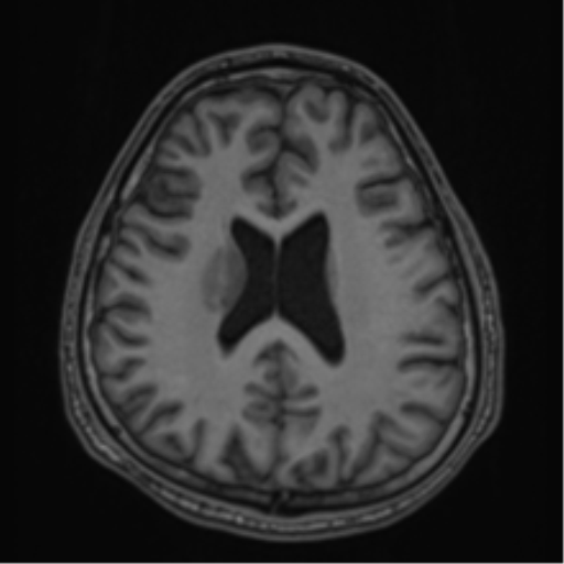 CNS vasculitis (Radiopaedia 55715-62263 Axial T1 53).png