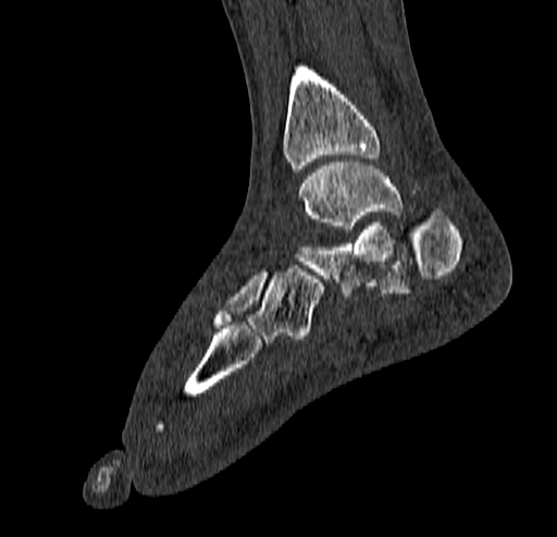 Calcaneal fracture - Sanders type 4 (Radiopaedia 90179-107370 Sagittal bone window 54).jpg