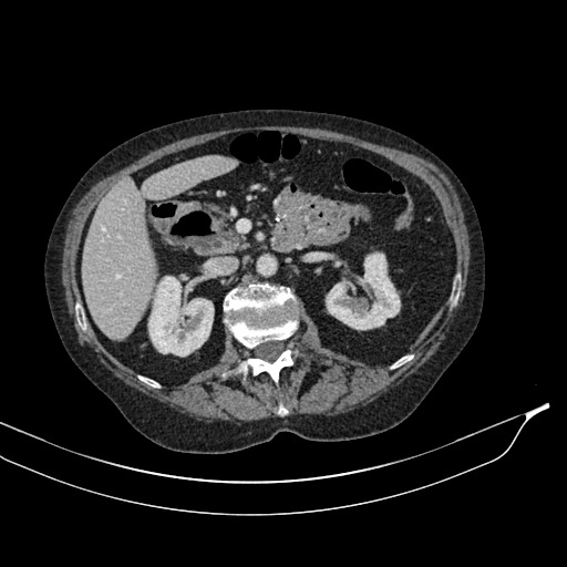 Calcified adrenal glands and Spigelian hernia (Radiopaedia 49741-54988 A 79).jpg