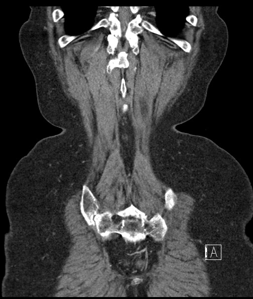 Calcified adrenal glands and Spigelian hernia (Radiopaedia 49741-54988 B 107).jpg