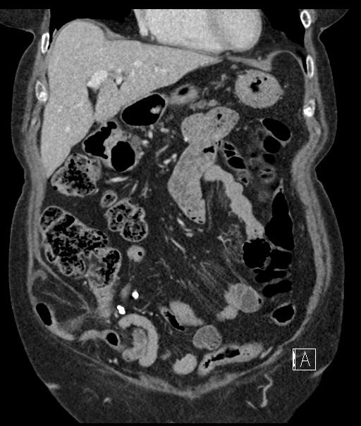 Calcified adrenal glands and Spigelian hernia (Radiopaedia 49741-54988 B 34).jpg