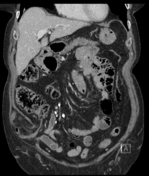 Calcified adrenal glands and Spigelian hernia (Radiopaedia 49741-54988 B 37).jpg