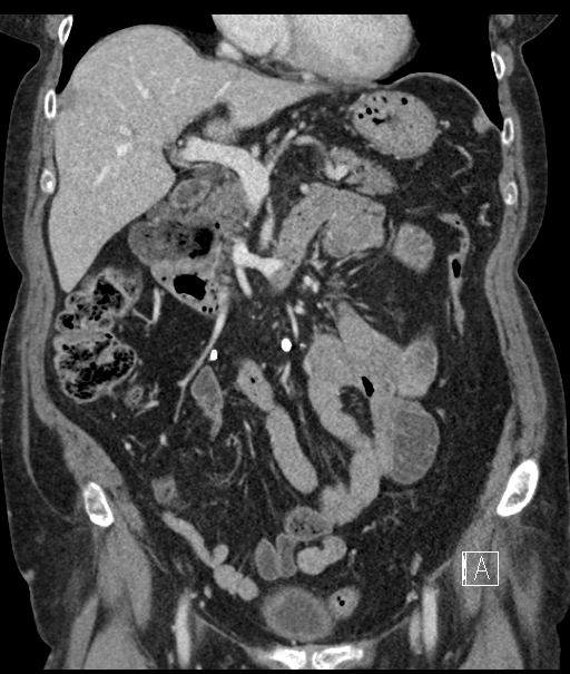 Calcified adrenal glands and Spigelian hernia (Radiopaedia 49741-54988 B 45).jpg