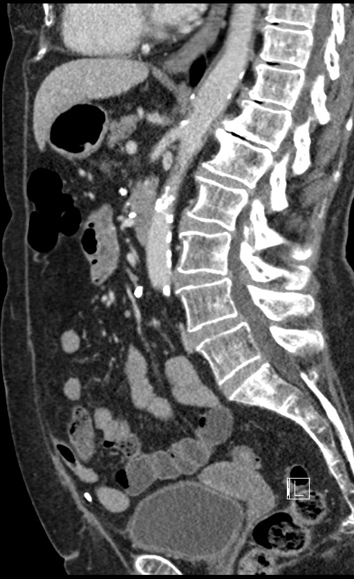 Calcified adrenal glands and Spigelian hernia (Radiopaedia 49741-54988 C 79).jpg