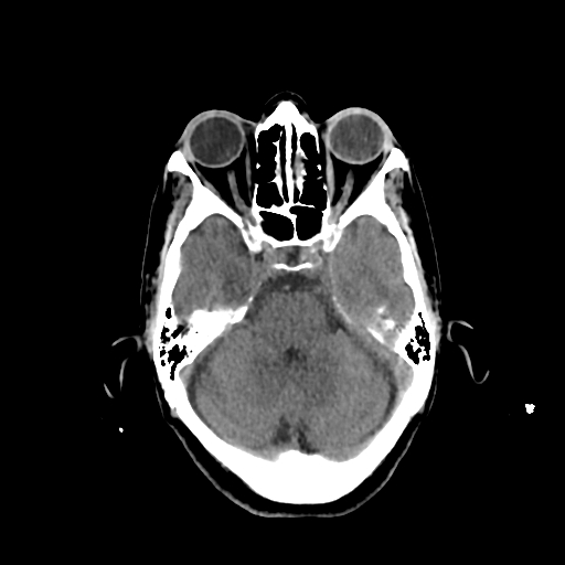 File:Calcified meningioma - cervical canal (Radiopaedia 70136-80171 Axial non-contrast 9).jpg