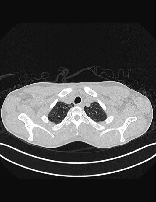 Calcifying pulmonary metastases (Radiopaedia 33359-34396 Axial lung window 7).jpg