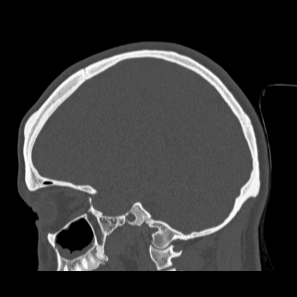 Calvarial osteoma (Radiopaedia 36520-38079 Sagittal bone window 42).jpg