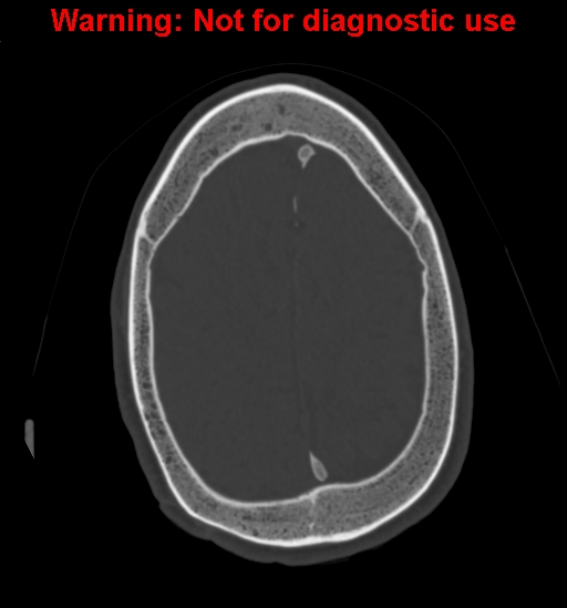 Calvarial thickening from chronic shunting (Radiopaedia 60079-67637 Axial bone window 141).jpg