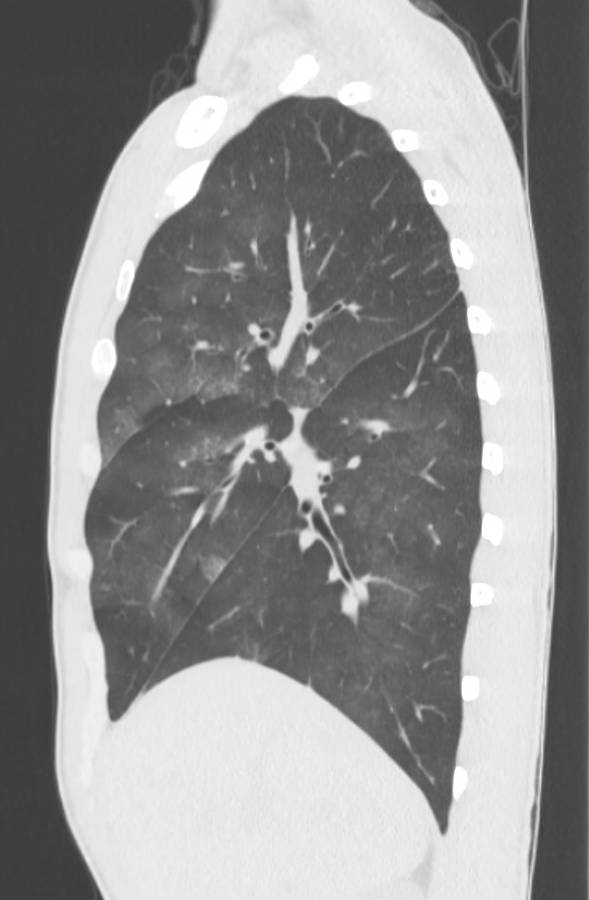 Cannabis-induced diffuse alveolar hemorrhage (Radiopaedia 89834-106946 Sagittal lung window 42).jpg