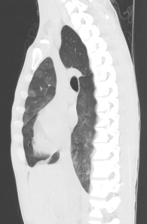 Cannabis-induced diffuse alveolar hemorrhage (Radiopaedia 89834-106946 Sagittal lung window 61).jpg