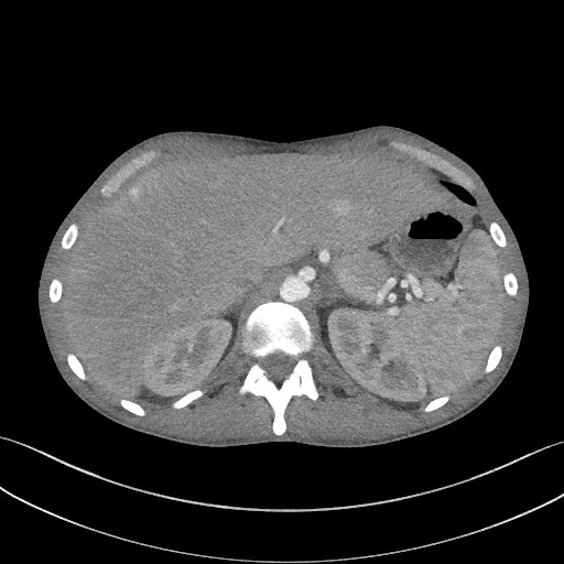 Cannonball metastases - testicular choriocarcinoma (Radiopaedia 84510-99891 B 106).jpg