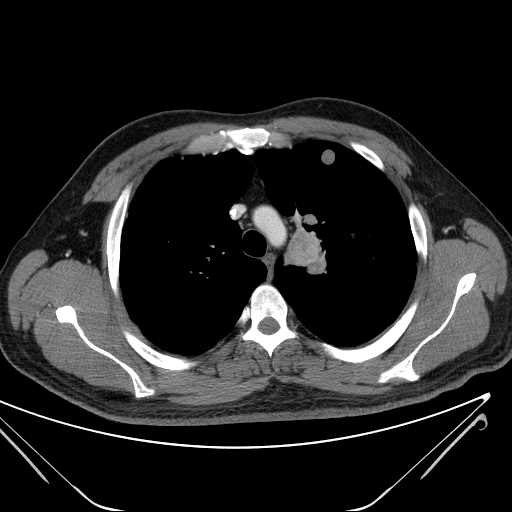 File:Cannonball pulmonary metastases (Radiopaedia 67684-77101 D 81).jpg