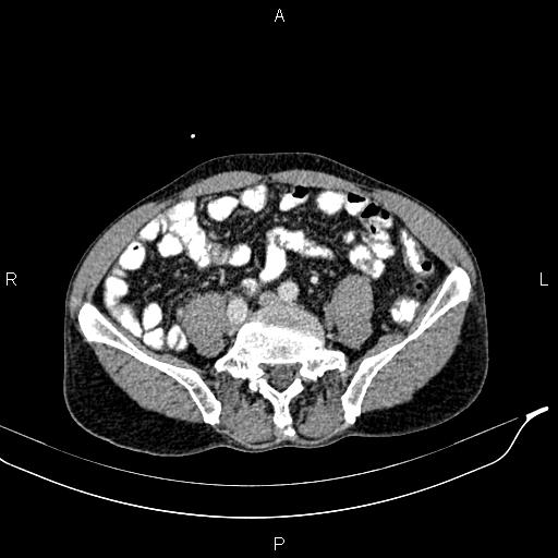 Caput medusae sign - portal hypertension (Radiopaedia 64007-72759 A 66).jpg