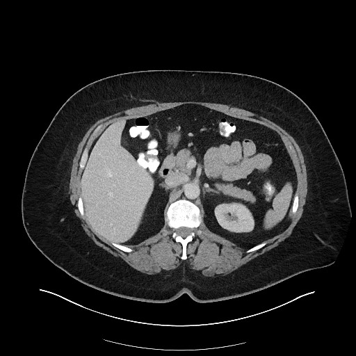 File:Carcinoid tumor - terminal ileum (Radiopaedia 60931-68739 Axial 51).jpg