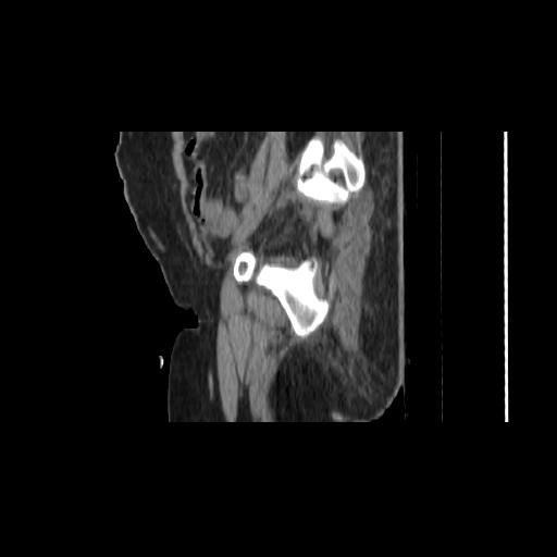 File:Carcinoma cervix- brachytherapy applicator (Radiopaedia 33135-34173 D 35).jpg