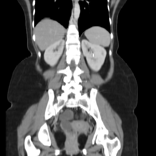 File:Carcinoma colon - hepatic flexure (Radiopaedia 19461-19493 B 28).jpg