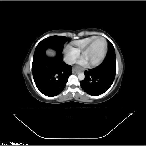 File:Carcinoma of esophagus (Radiopaedia 27356-27550 A 13).jpg