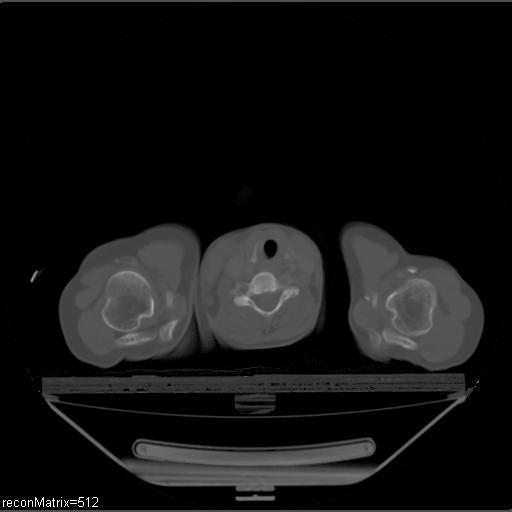 File:Carcinoma of esophagus (Radiopaedia 27356-27550 Axial bone window 35).jpg