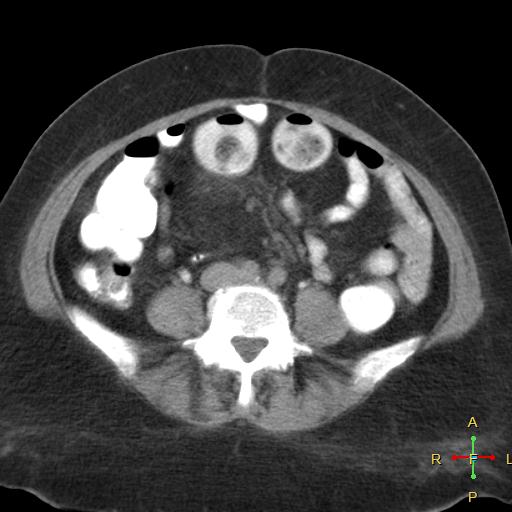 File:Carcinoma of sigmoid colon (Radiopaedia 23071-23100 C+ delayed 15).jpg