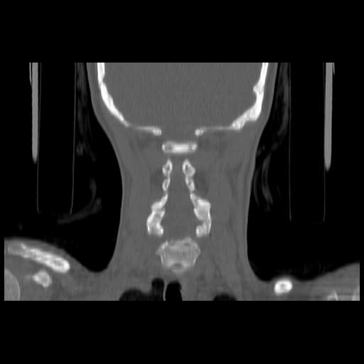 Carcinoma of the maxillary antrum (Radiopaedia 53805-59888 Coronal bone window 116).jpg