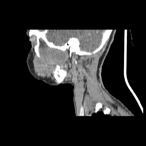Carcinoma of the maxillary antrum (Radiopaedia 53805-59888 Sagittal C+ delayed 49).jpg