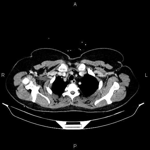 Carcinoma of uterine cervix (Radiopaedia 85861-101700 A 9).jpg