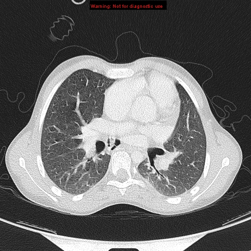 File:Cardiac bronchus (Radiopaedia 14059-13899 A 21).jpg