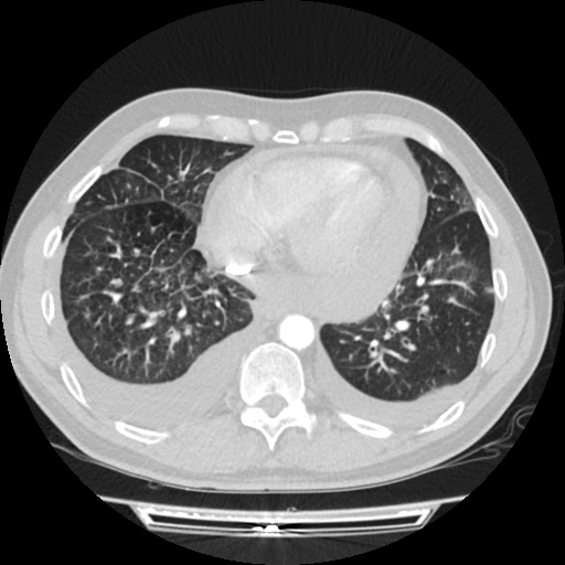 Cardiac tamponade (Radiopaedia 78607-91368 Axial lung window 64).jpg