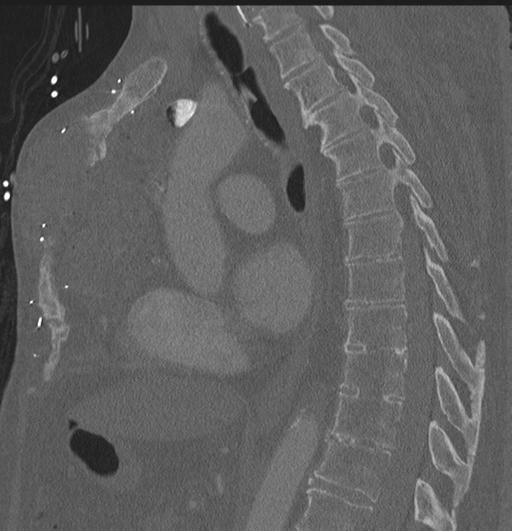 File:Cardiac trauma (Radiopaedia 32874-33858 Sagittal bone window 37).jpg