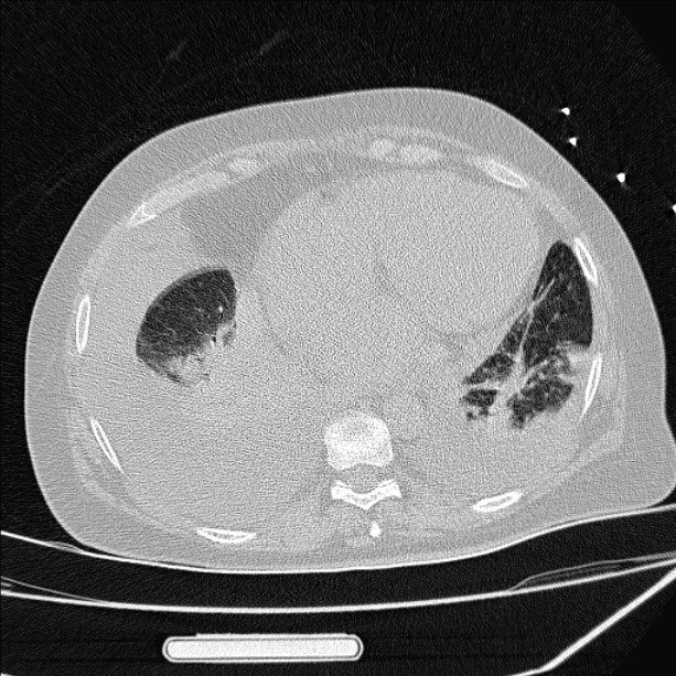 Cardiogenic pulmonary edema (Radiopaedia 29213-29609 Axial lung window 74).jpg