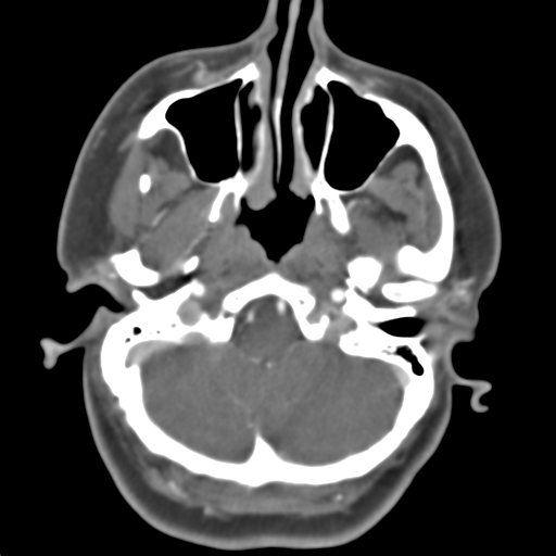 Carotico ophthalmic aneurysm (Radiopaedia 42916-46148 A 45).png