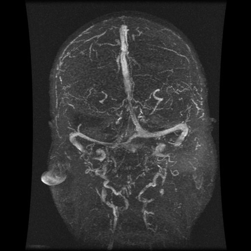 File:Carotid arterial dissection with acute cerebral infarction (Radiopaedia 26636-26784 MRV 1).jpg
