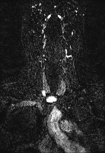 File:Carotid artery dissection (Radiopaedia 28441-28689 Coronal MRA 19).jpg