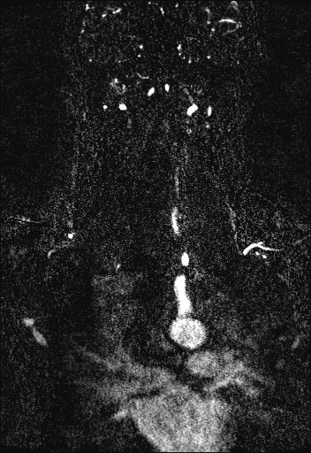 File:Carotid artery dissection (Radiopaedia 28441-28689 Coronal MRA 64).jpg