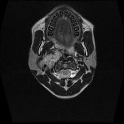 File:Carotid body tumor (Radiopaedia 30208-30823 Axial T2 13).jpg