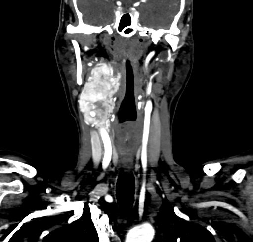 File:Carotid body tumor (Radiopaedia 83615-98727 B 64).jpg