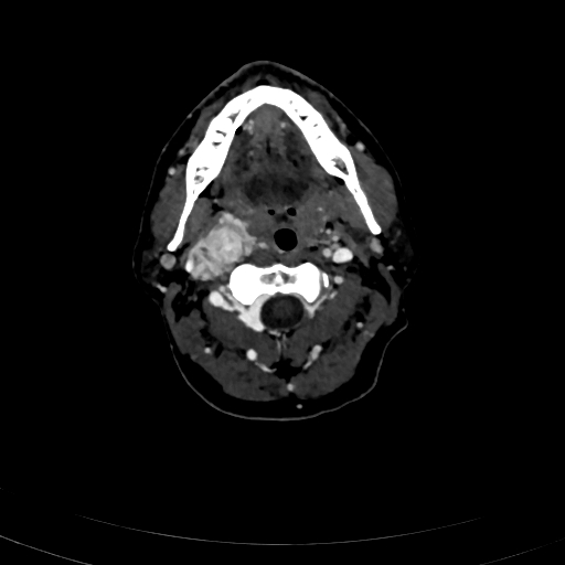 Carotid body tumor (Radiopaedia 83615-98727 D 46).jpg