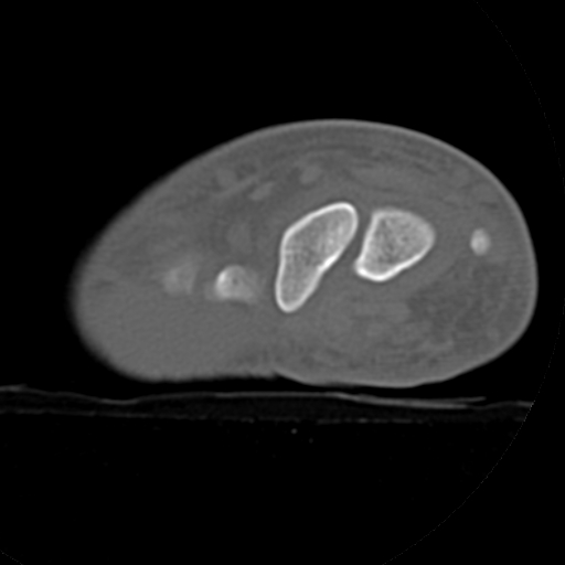 File:Carpo-metacarpal fracture-dislocations with hamatum split fracture (Radiopaedia 18482-18343 Axial bone window 26).jpg