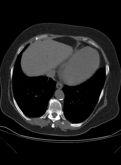 File:Caseous mitral annular calcification (Radiopaedia 61219-69122 Axial non-contrast 19).jpg