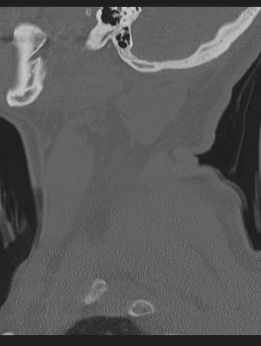 Cavernoma of cervical cord (Radiopaedia 50838-56346 Sagittal bone window 9).png