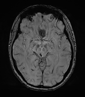 File:Cavernoma with bleed - midbrain (Radiopaedia 54546-60773 Axial SWI 22).png