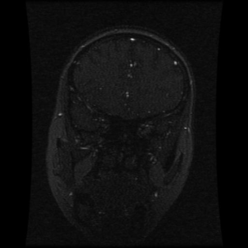 Cavernoma with developmental venous anomaly (Radiopaedia 22470-22507 MRV 94).jpg