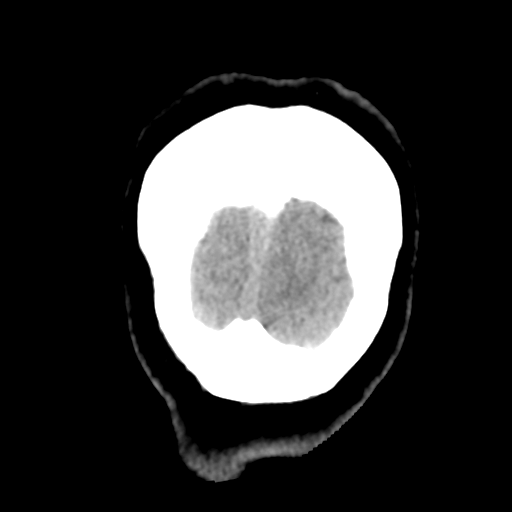 Cavernoma with hemorrhage (Radiopaedia 70755-80931 Coronal non-contrast 59).png