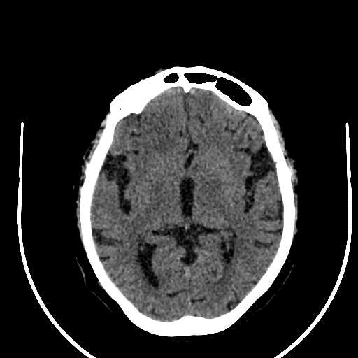 Cavernous hemangioma of the cerebellar falx (Radiopaedia 73025-83723 Axial non-contrast 66).jpg