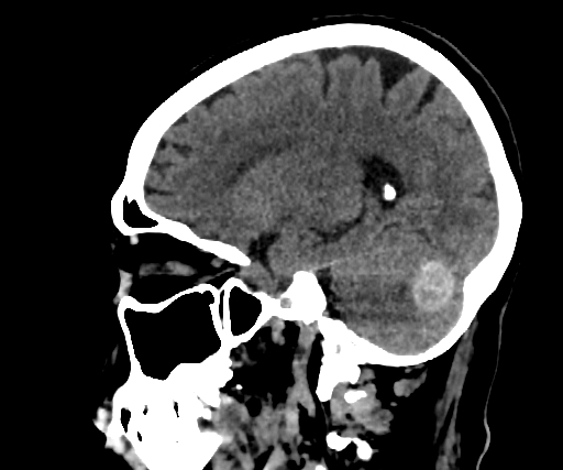 Cavernous hemangioma of the cerebellar falx (Radiopaedia 73025-83723 B 210).jpg