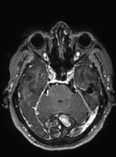 Cavernous hemangioma of the cerebellar falx (Radiopaedia 73025-83724 Axial T1 C+ 233).jpg