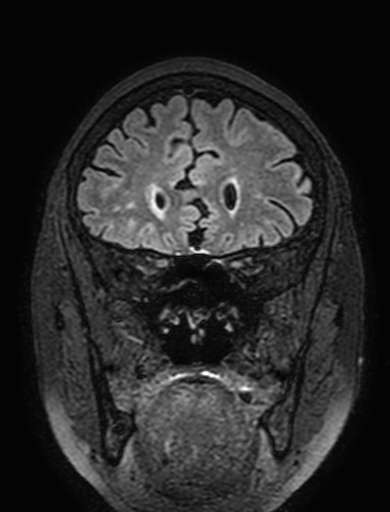 Cavernous hemangioma of the cerebellar falx (Radiopaedia 73025-83724 Coronal FLAIR 91).jpg